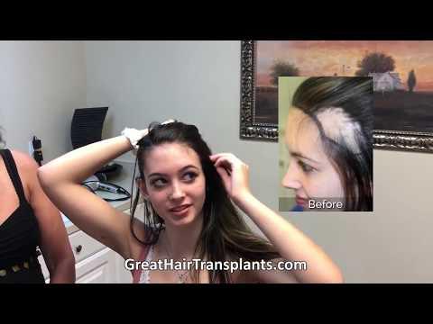 Hair Transplant Videos