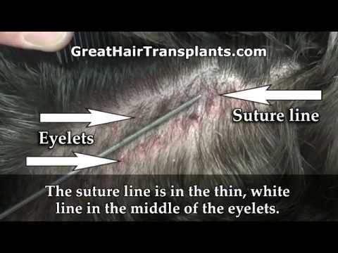 Hair Transplant Videos