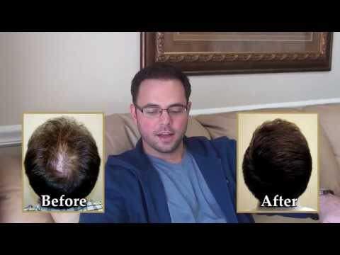 Hair Transplant Videos