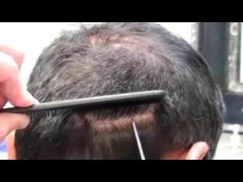 Hair Transplant Videos