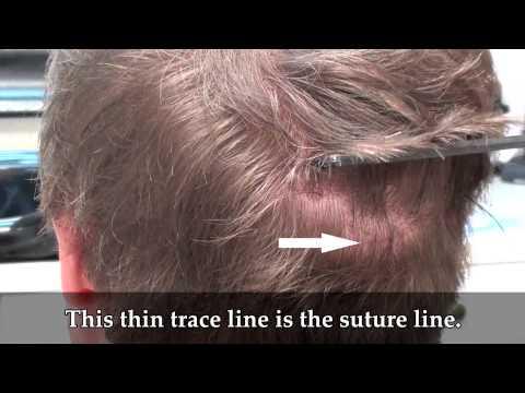 Hair Transplant Videos