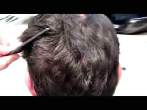 Hair Transplant Videos