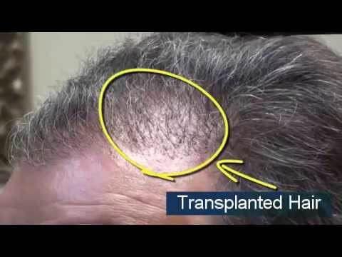 Hair Transplant Video