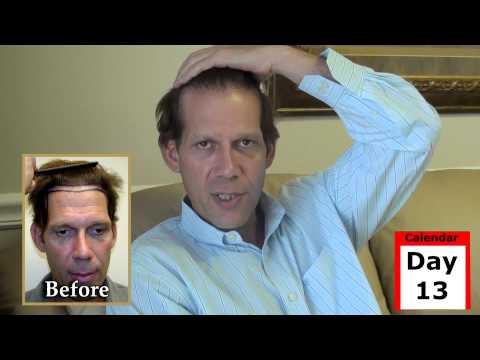 Hair Transplant Videos