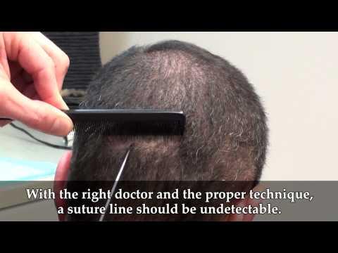 Hair Transplant Videos