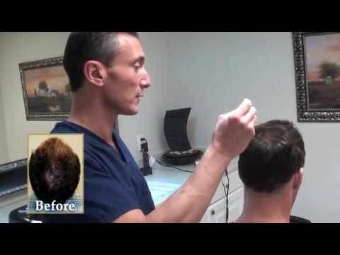 Hair Transplant Videos