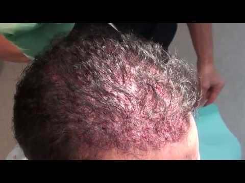 Hair Transplant Videos