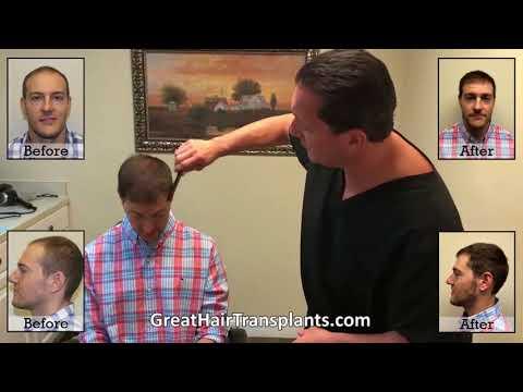 Hair Transplant Video