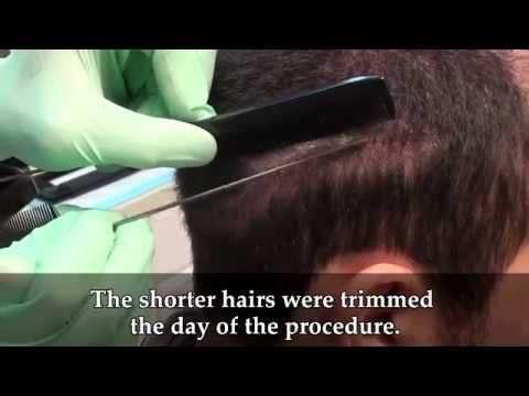 Dr. Brett Bolton Another Undetectable Hair Transplant Scar