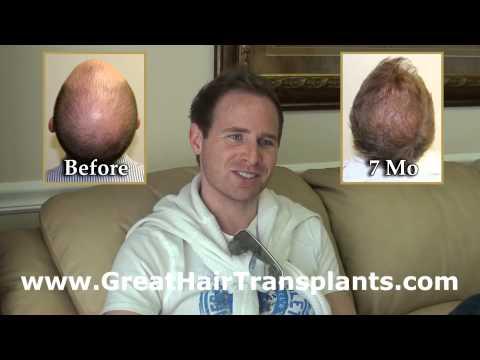 Hair Transplant Videos