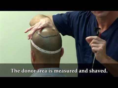 Hair Transplant Video