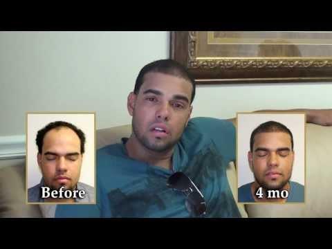 Hair Transplant Videos