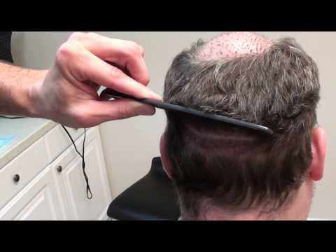 Hair Transplant Videos