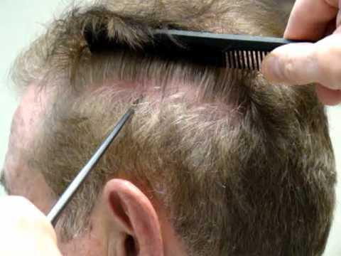 Hair Transplant Videos