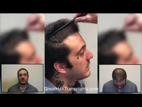 Hair Transplant Videos