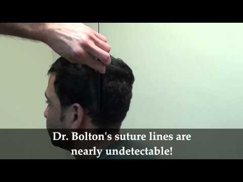 Hair Transplant Videos