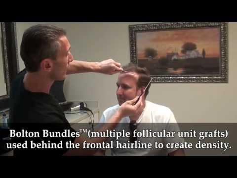 Hair Transplant Videos