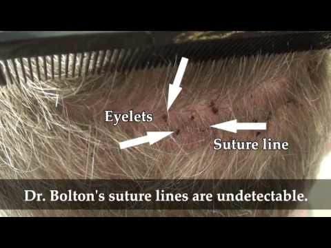 Hair Transplant Videos