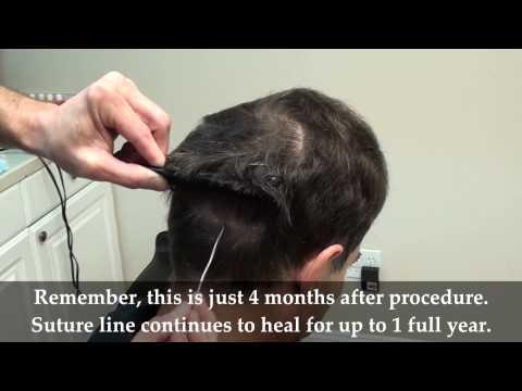 Hair Transplant Videos