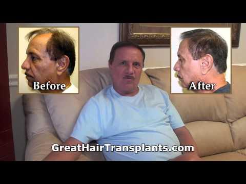 Hair Transplant Videos