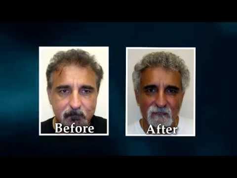 Hair Transplant Videos