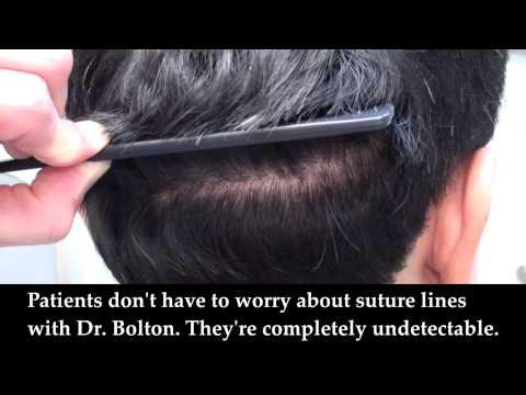 Hair Transplant Videos