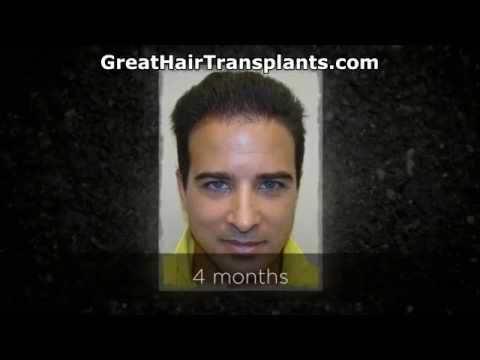 Hair Transplant Videos