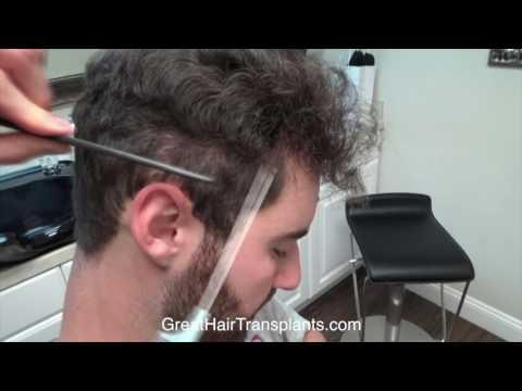 Hair Transplant Videos