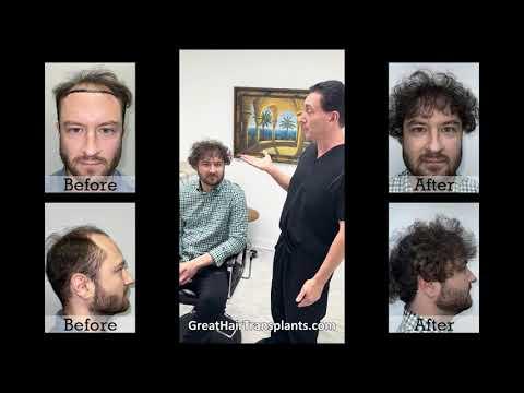 Hair Transplant Video