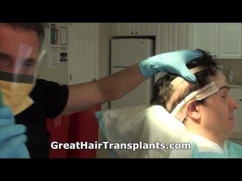 Hair Transplant Videos