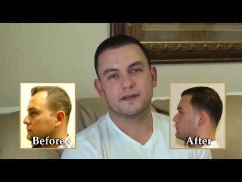 Hair Transplant Video