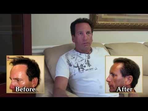 Hair Transplant Video