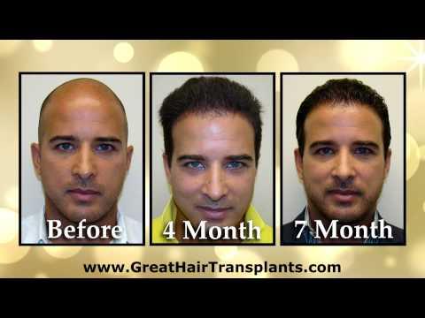 Hair Transplant Videos