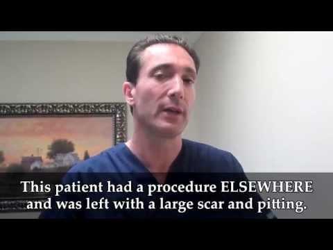 Hair Transplant Video