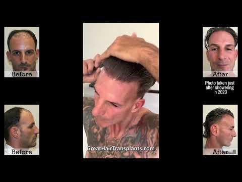 Hair Transplant Videos