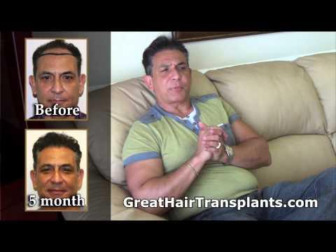 Hair Transplant Video