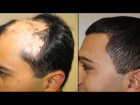 Hair Transplant Videos