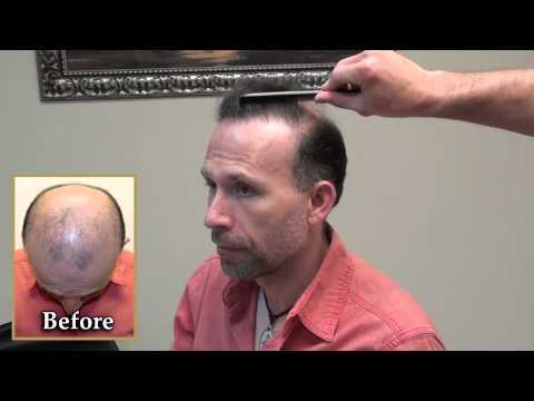 Hair Transplant Video