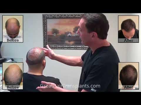 Hair Transplant Videos