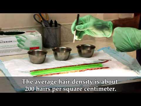 Hair Transplant Videos