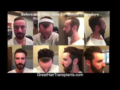 Hair Transplant Videos