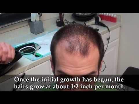 Hair Transplant Video