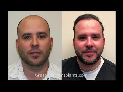 Hair Transplant Videos