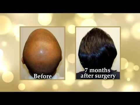 Hair Transplant Video