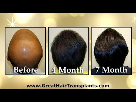 Hair Transplant Videos