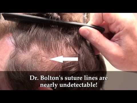 Hair Transplant Videos