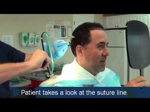 Hair Transplant Videos