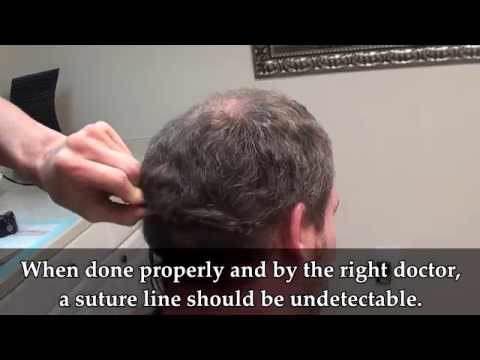 Hair Transplant Videos