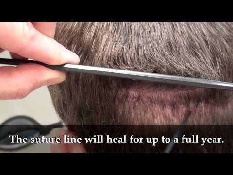 Hair Transplant Videos