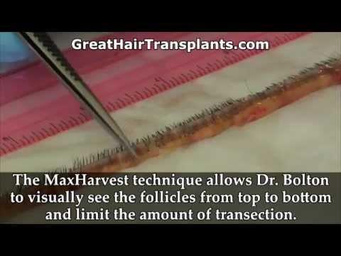 Hair Transplant Videos